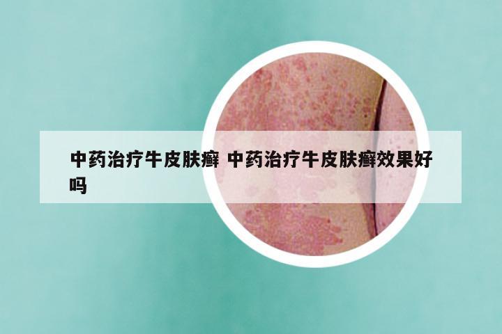 中药治疗牛皮肤癣 中药治疗牛皮肤癣效果好吗