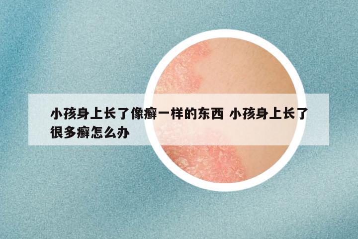 小孩身上长了像癣一样的东西 小孩身上长了很多癣怎么办
