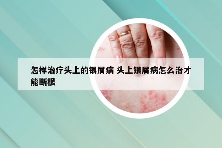 怎样治疗头上的银屑病 头上银屑病怎么治才能断根
