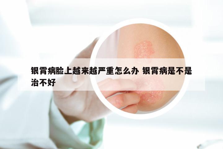 银霄病脸上越来越严重怎么办 银霄病是不是治不好