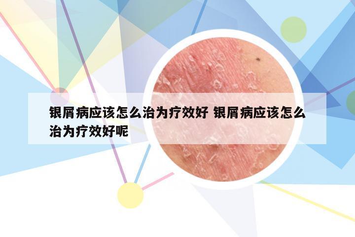 银屑病应该怎么治为疗效好 银屑病应该怎么治为疗效好呢