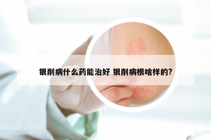 银削病什么药能治好 银削病根啥样的?
