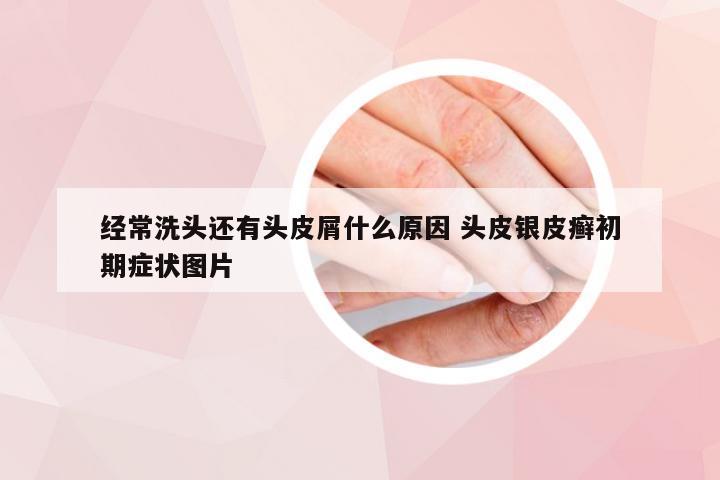经常洗头还有头皮屑什么原因 头皮银皮癣初期症状图片