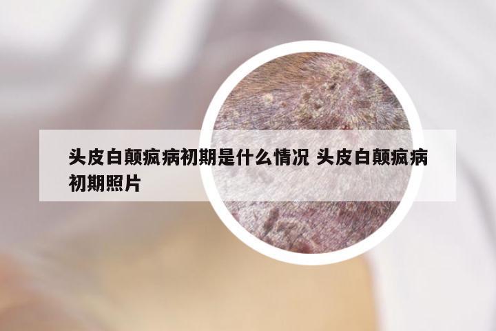 头皮白颠疯病初期是什么情况 头皮白颠疯病初期照片
