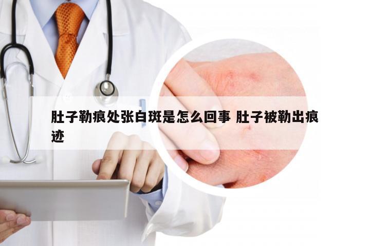 肚子勒痕处张白斑是怎么回事 肚子被勒出痕迹