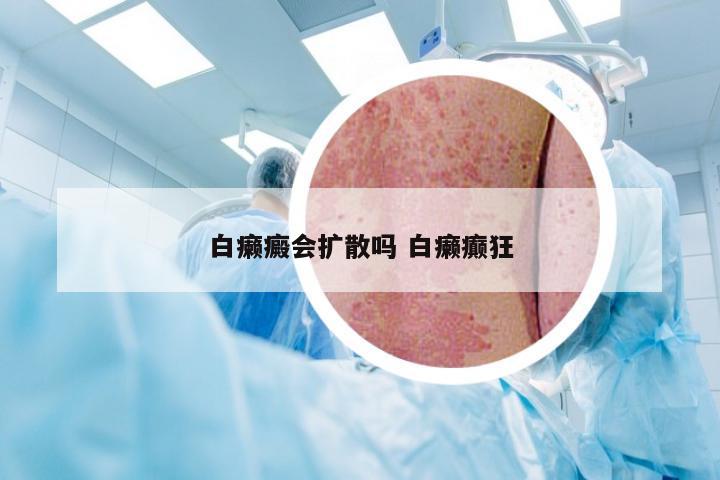 白癞癜会扩散吗 白癞癫狂