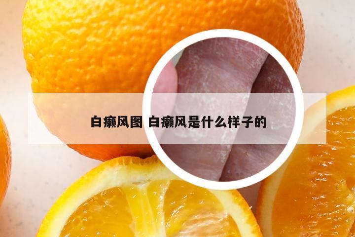白癞风图 白癞风是什么样子的