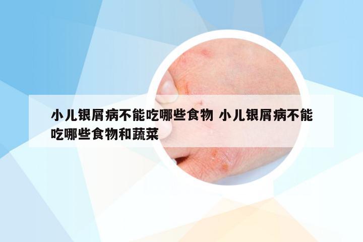 小儿银屑病不能吃哪些食物 小儿银屑病不能吃哪些食物和蔬菜