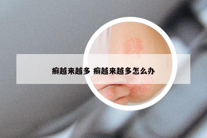 癣越来越多 癣越来越多怎么办