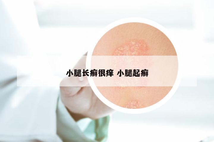 小腿长癣很痒 小腿起癣