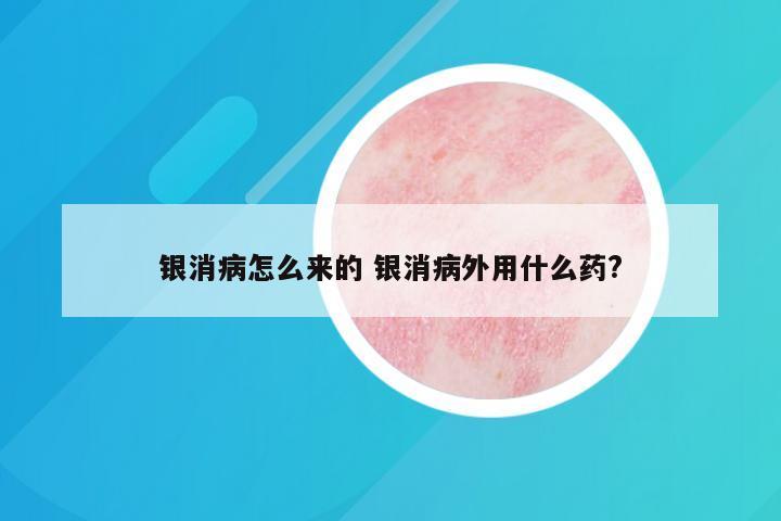 银消病怎么来的 银消病外用什么药?