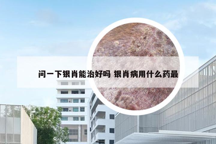 问一下银肖能治好吗 银肖病用什么药最