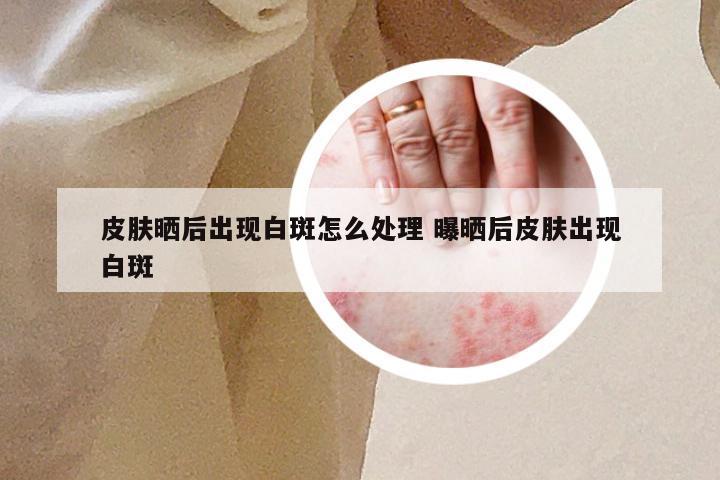 皮肤晒后出现白斑怎么处理 曝晒后皮肤出现白斑