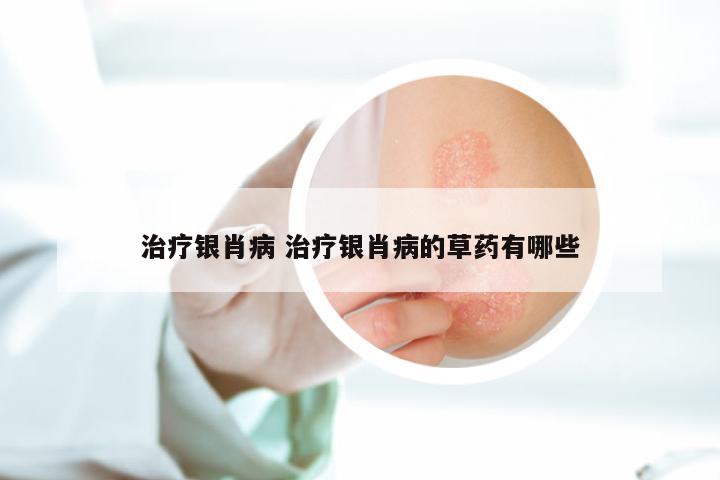治疗银肖病 治疗银肖病的草药有哪些
