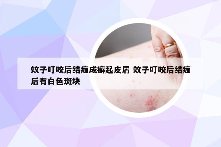 蚊子叮咬后结痂成癣起皮屑 蚊子叮咬后结痂后有白色斑块
