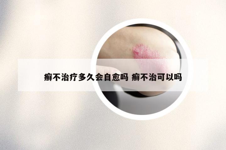癣不治疗多久会自愈吗 癣不治可以吗
