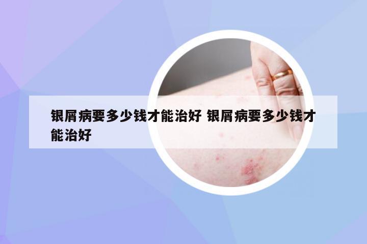 银屑病要多少钱才能治好 银屑病要多少钱才能治好