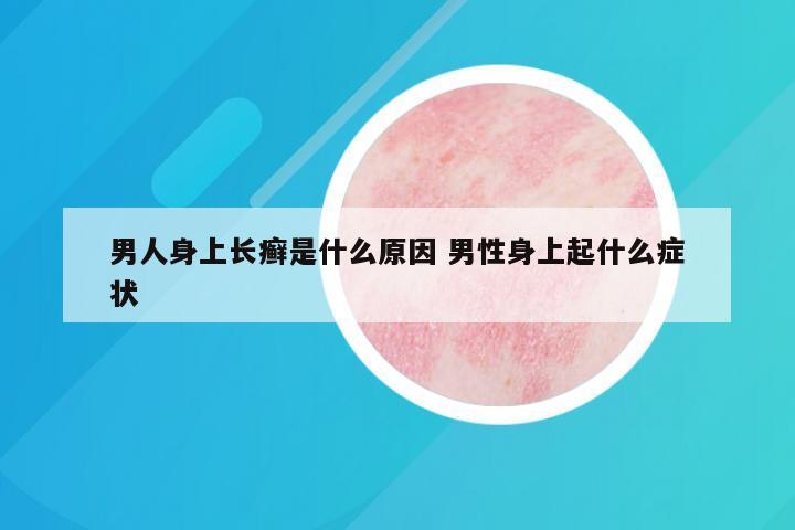 男人身上长癣是什么原因 男性身上起什么症状