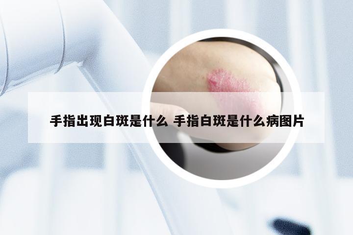 手指出现白斑是什么 手指白斑是什么病图片