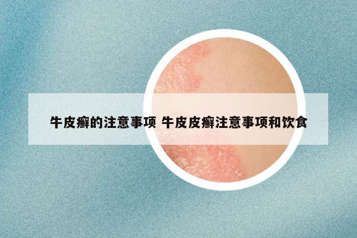 牛皮癣的注意事项 牛皮皮癣注意事项和饮食