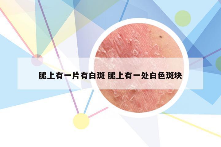 腿上有一片有白斑 腿上有一处白色斑块