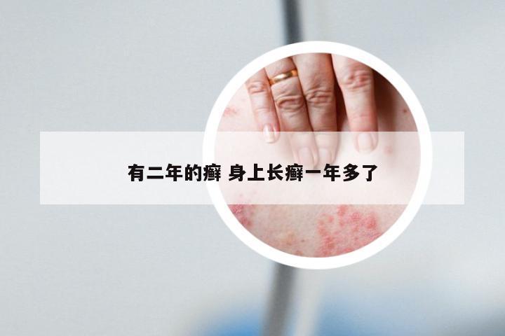 有二年的癣 身上长癣一年多了