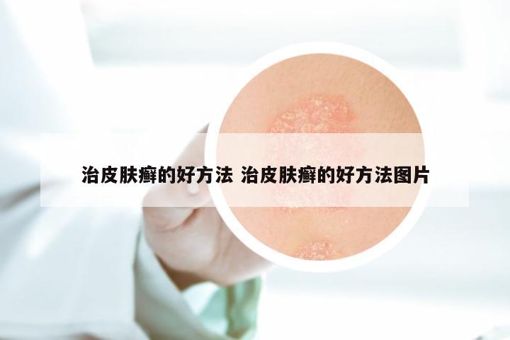 治皮肤癣的好方法 治皮肤癣的好方法图片