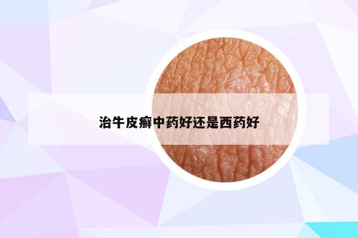 治牛皮癣中药好还是西药好