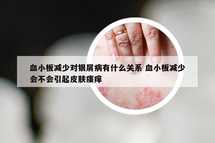 血小板减少对银屑病有什么关系 血小板减少会不会引起皮肤瘙痒