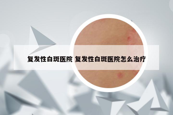 复发性白斑医院 复发性白斑医院怎么治疗