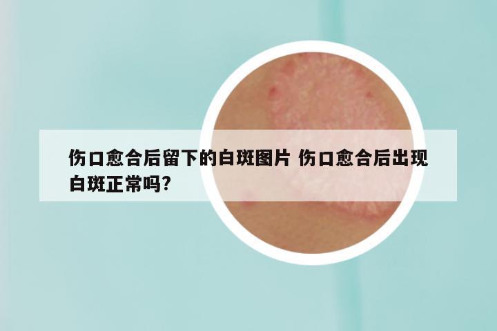 伤口愈合后留下的白斑图片 伤口愈合后出现白斑正常吗?