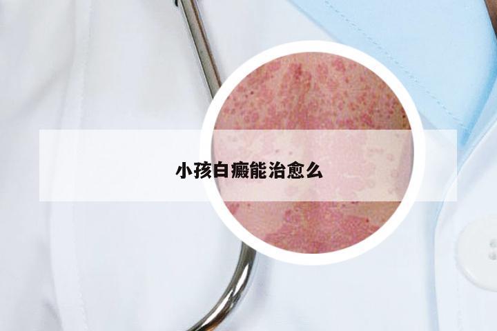 小孩白癜能治愈么