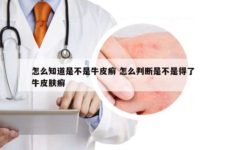怎么知道是不是牛皮癣 怎么判断是不是得了牛皮肤癣