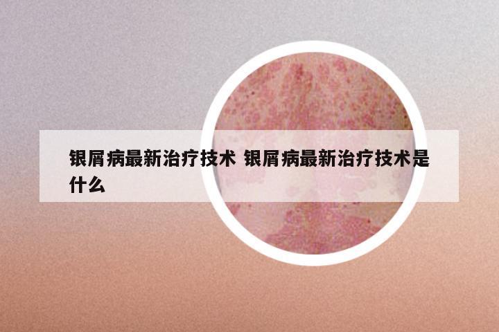 银屑病最新治疗技术 银屑病最新治疗技术是什么