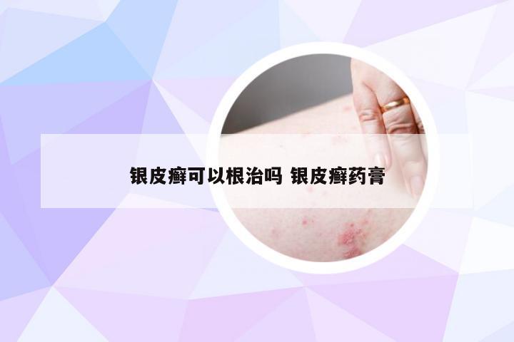 银皮癣可以根治吗 银皮癣药膏