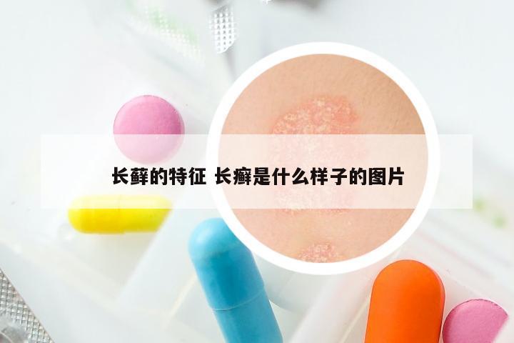 长藓的特征 长癣是什么样子的图片