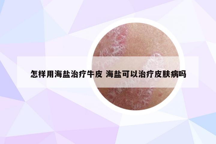 怎样用海盐治疗牛皮 海盐可以治疗皮肤病吗