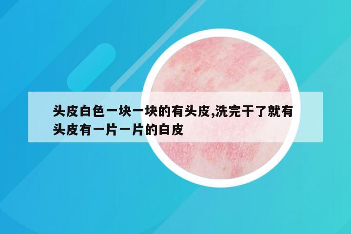 头皮白色一块一块的有头皮,洗完干了就有 头皮有一片一片的白皮