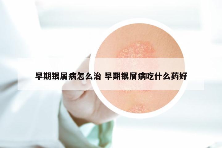 早期银屑病怎么治 早期银屑病吃什么药好
