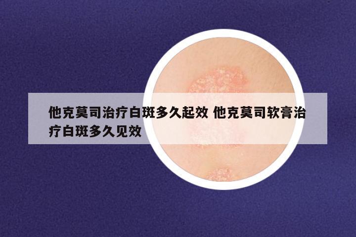 他克莫司治疗白斑多久起效 他克莫司软膏治疗白斑多久见效