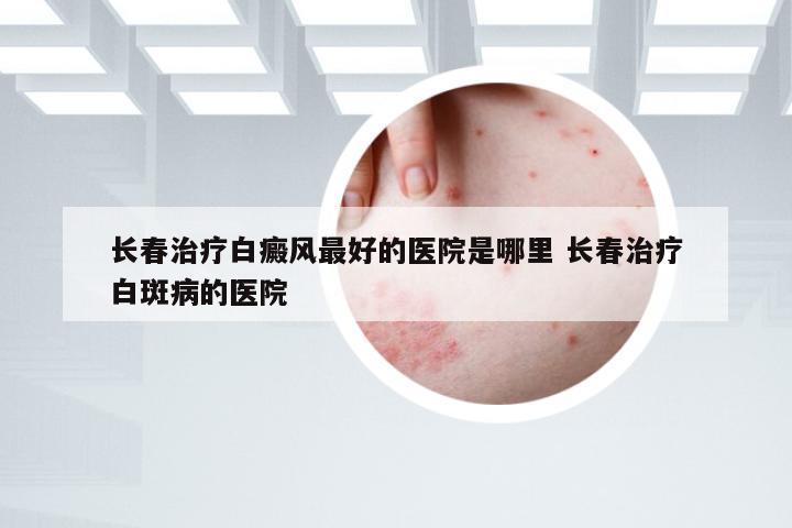 长春治疗白癜风最好的医院是哪里 长春治疗白斑病的医院