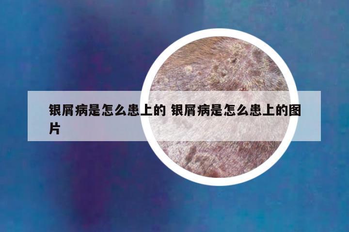 银屑病是怎么患上的 银屑病是怎么患上的图片