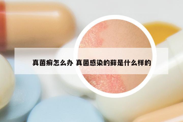 真菌癣怎么办 真菌感染的藓是什么样的