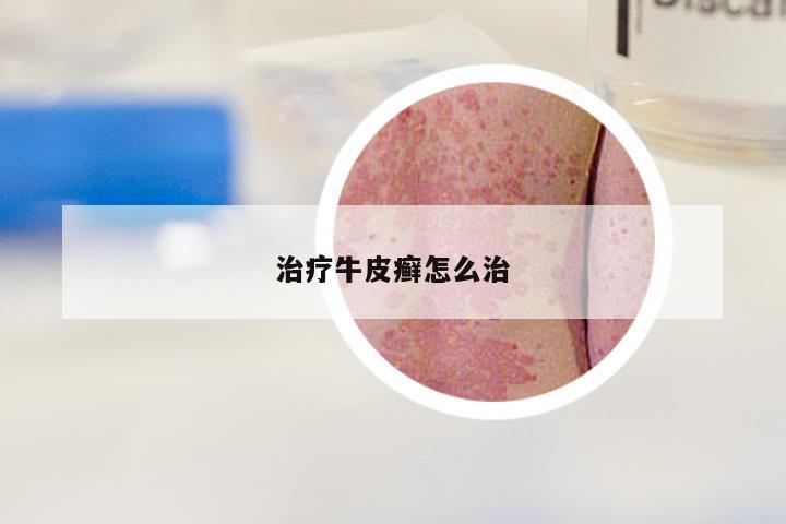 治疗牛皮癣怎么治