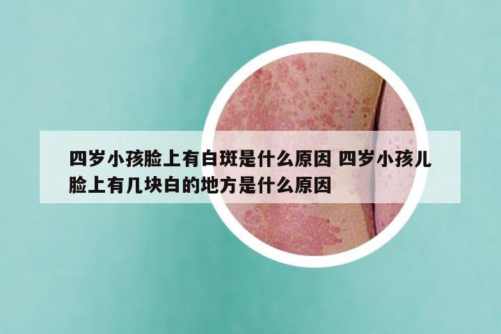 四岁小孩脸上有白斑是什么原因 四岁小孩儿脸上有几块白的地方是什么原因