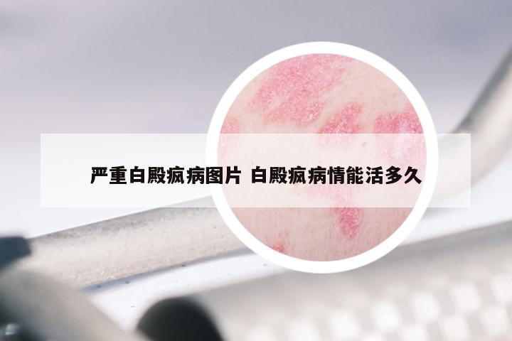 严重白殿疯病图片 白殿疯病情能活多久