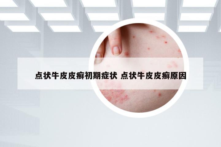 点状牛皮皮癣初期症状 点状牛皮皮癣原因