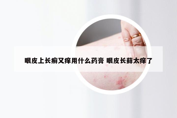 眼皮上长癣又痒用什么药膏 眼皮长藓太痒了