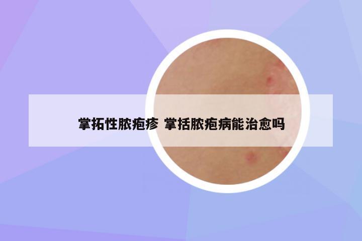 掌拓性脓疱疹 掌括脓疱病能治愈吗