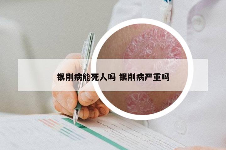 银削病能死人吗 银削病严重吗